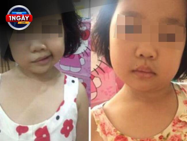 Mùa Hè An Toàn Cho Bé: Phòng Ngừa Liệt Mặt Hiệu Quả Nhờ Chủ Động Chăm Sóc