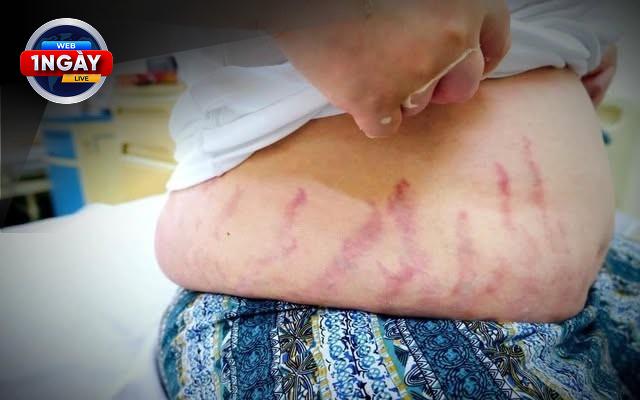 Biến Chứng Bàn Chân Do Tiểu Đường: Nguyên Nhân Và Cách Phòng Ngừa