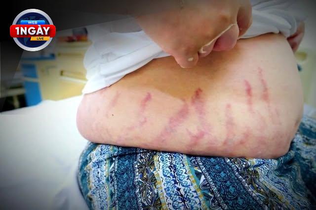 Lời Khuyên Từ Chuyên Gia: Sử Dụng Corticoid An Toàn Cho Trẻ